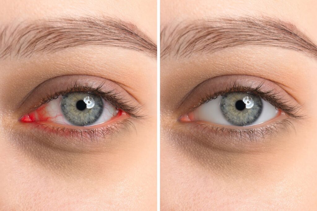 A close-up image comparing an eye with pink eye to a healthy eye